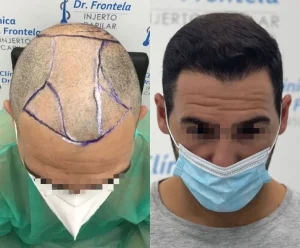 resultado de injerto capilar en sevilla