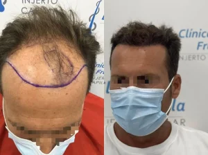 resultado de injerto capilar en sevilla