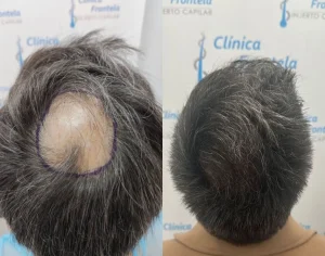 resultado de injerto capilar en sevilla