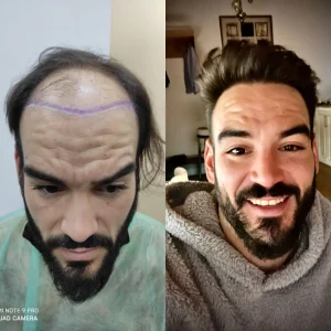 resultado de injerto capilar en sevilla