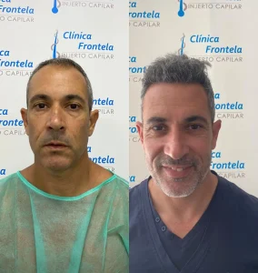 injerto capilar sevilla