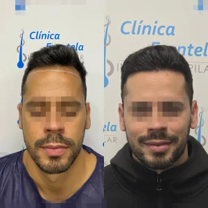 clínica capilar en Málaga