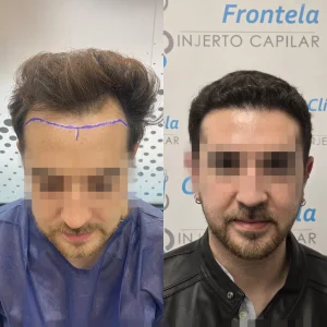 implante capilar en Sevilla