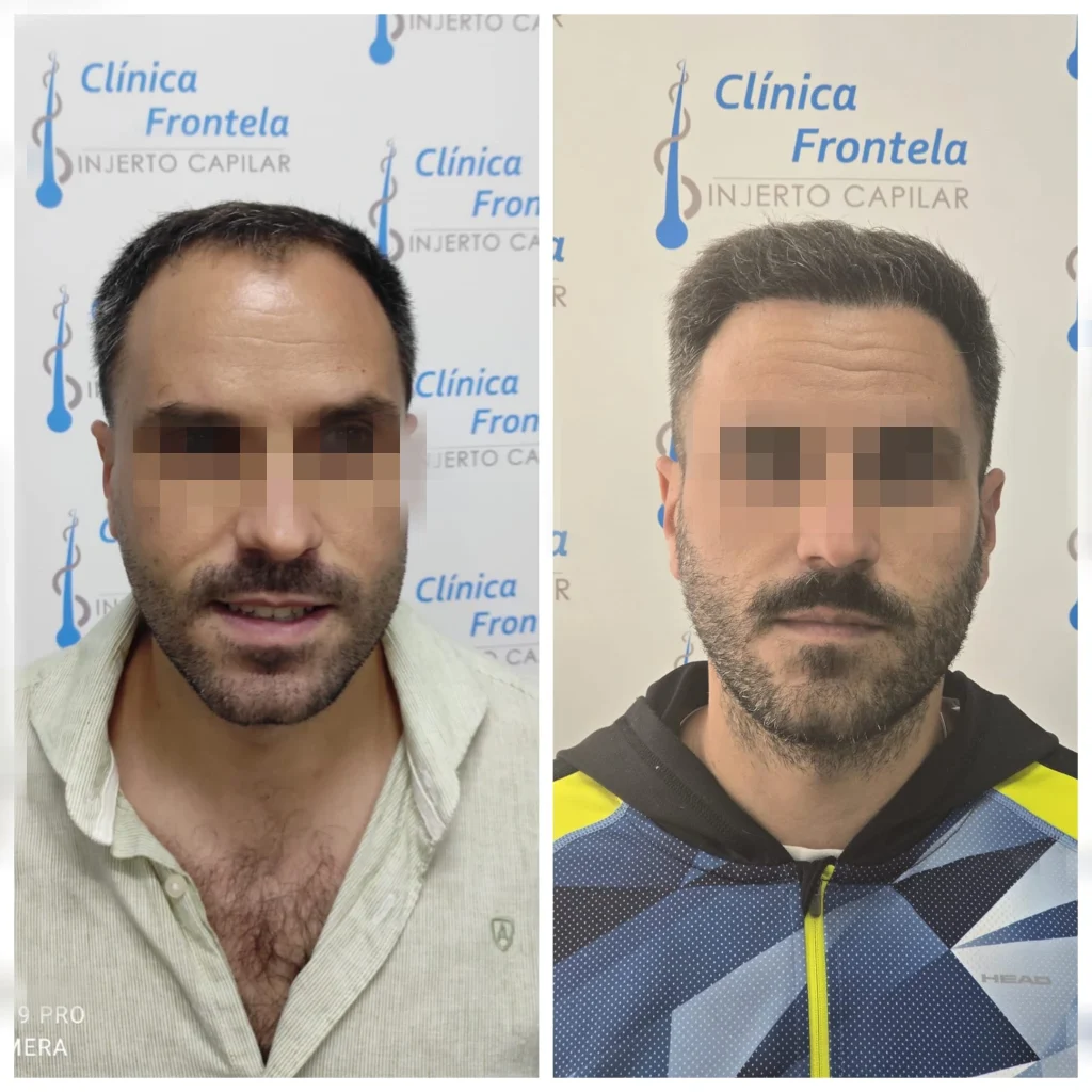 injerto capilar en Madrid