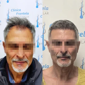 clínica capilar en Sevilla